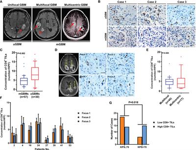 Decreased CD8+ Lymphocytic Infiltration in Multifocal and Multicentric Glioblastomas